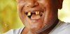 54513636-broken-tooth-with-smile-old-man.jpg
