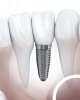 difference-implant-couronne-2.jpg